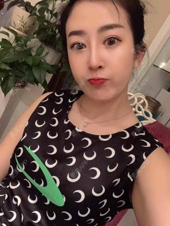 更美 - 更美用户eQZyR2BAtN的膨体隆鼻经验 | 肋软骨隆鼻 | 膨体隆鼻 | 埋线隆鼻 | 耳软骨隆鼻 | 鼻翼缩小