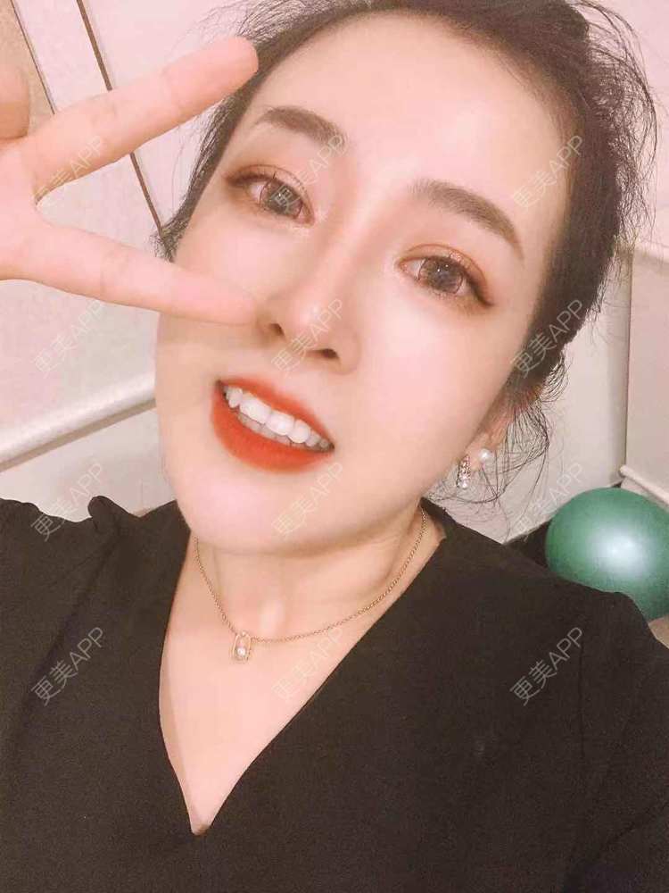 更美 - 更美用户eQZyR2BAtN的膨体隆鼻经验 | 肋软骨隆鼻 | 膨体隆鼻 | 埋线隆鼻 | 耳软骨隆鼻 | 鼻翼缩小