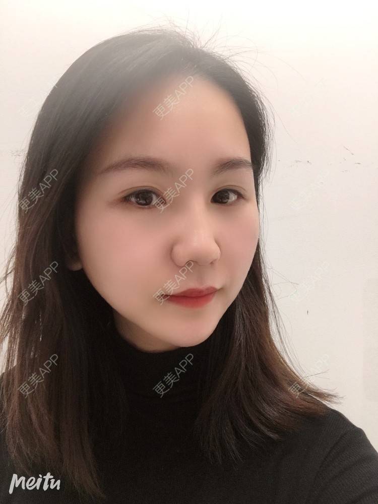 更美 - 怡你在这里吖的鼻部多项经验 | 鼻部多项 | 自体软骨垫鼻尖 | 鼻翼缩小 | 重庆 | 鼻中隔软骨隆鼻