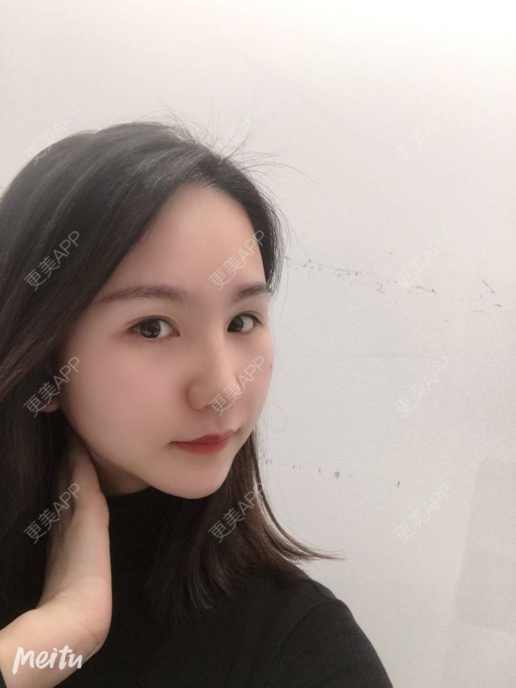 更美 - 怡你在这里吖的鼻部多项经验 | 鼻部多项 | 自体软骨垫鼻尖 | 鼻翼缩小 | 重庆 | 鼻中隔软骨隆鼻