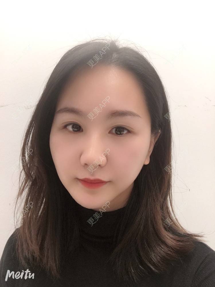 更美 - 怡你在这里吖的鼻部多项经验 | 鼻部多项 | 自体软骨垫鼻尖 | 鼻翼缩小 | 重庆 | 鼻中隔软骨隆鼻