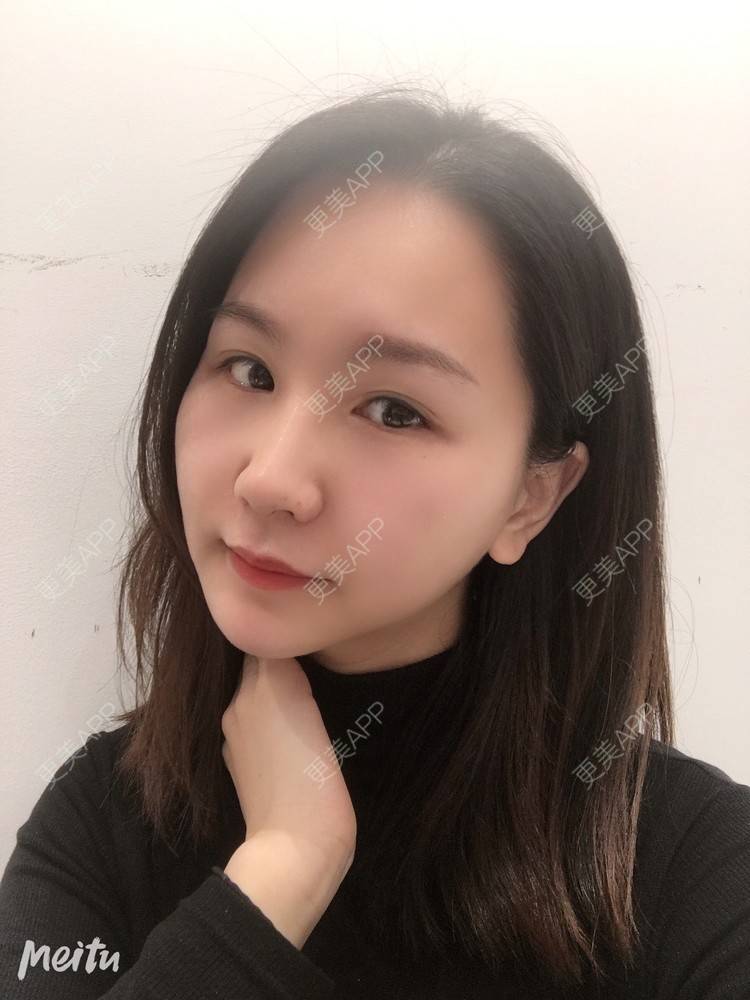 更美 - 怡你在这里吖的鼻部多项经验 | 鼻部多项 | 自体软骨垫鼻尖 | 鼻翼缩小 | 重庆 | 鼻中隔软骨隆鼻