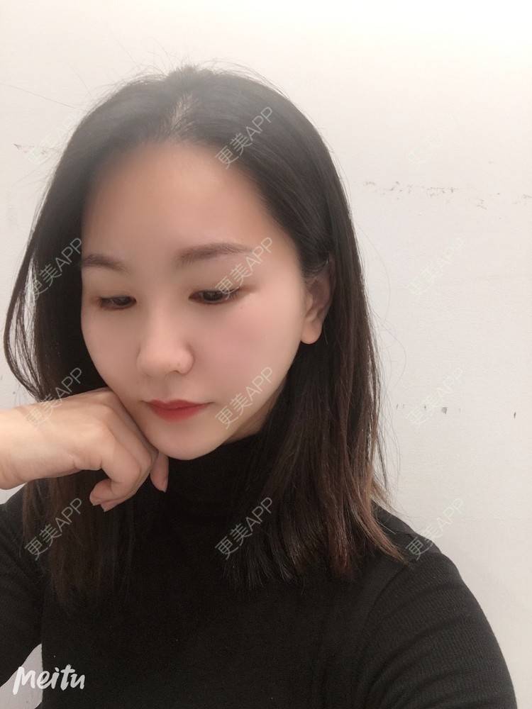 更美 - 怡你在这里吖的鼻部多项经验 | 鼻部多项 | 自体软骨垫鼻尖 | 鼻翼缩小 | 重庆 | 鼻中隔软骨隆鼻