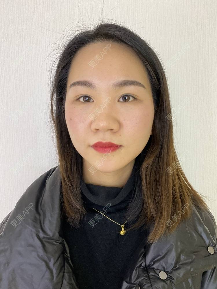 更美 - 怡你在这里吖的鼻部多项经验 | 鼻中隔软骨隆鼻 | 鼻翼缩小 | 鼻部多项 | 自体软骨垫鼻尖 | 重庆