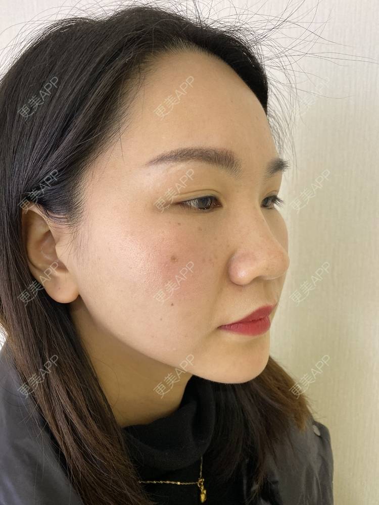 更美 - 怡你在这里吖的鼻部多项经验 | 鼻中隔软骨隆鼻 | 鼻翼缩小 | 鼻部多项 | 自体软骨垫鼻尖 | 重庆