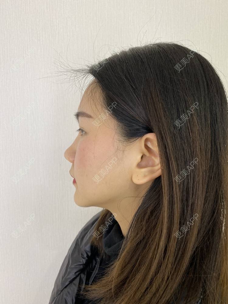 更美 - 怡你在这里吖的鼻部多项经验 | 鼻中隔软骨隆鼻 | 鼻翼缩小 | 鼻部多项 | 自体软骨垫鼻尖 | 重庆