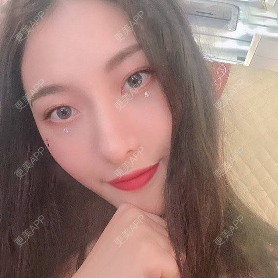 更美 - 木森曦夏荒凉年倬的双眼皮经验 | 双眼皮 | 曲靖