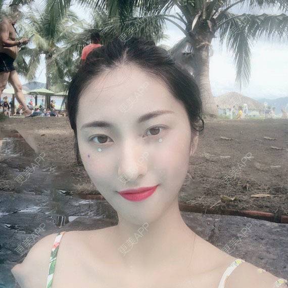 更美 - 木森曦夏荒凉年倬的双眼皮经验 | 双眼皮 | 曲靖