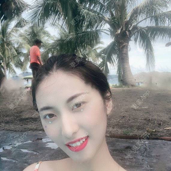 更美 - 木森曦夏荒凉年倬的双眼皮经验 | 双眼皮 | 曲靖