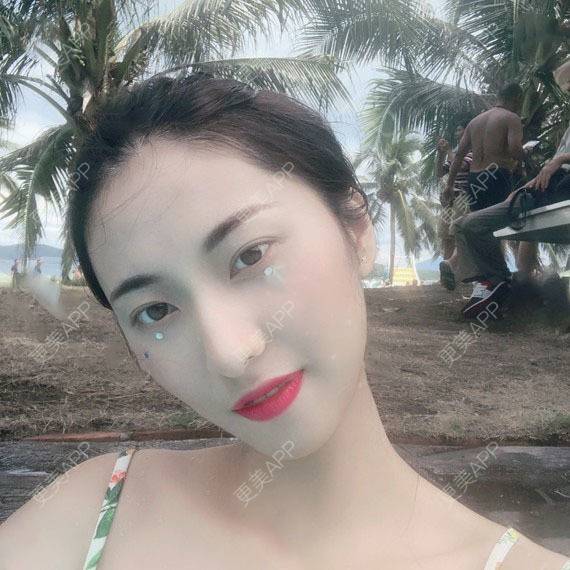 更美 - 木森曦夏荒凉年倬的双眼皮经验 | 双眼皮 | 曲靖