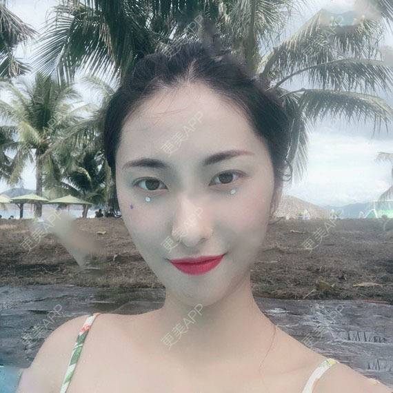 更美 - 木森曦夏荒凉年倬的双眼皮经验 | 双眼皮 | 曲靖