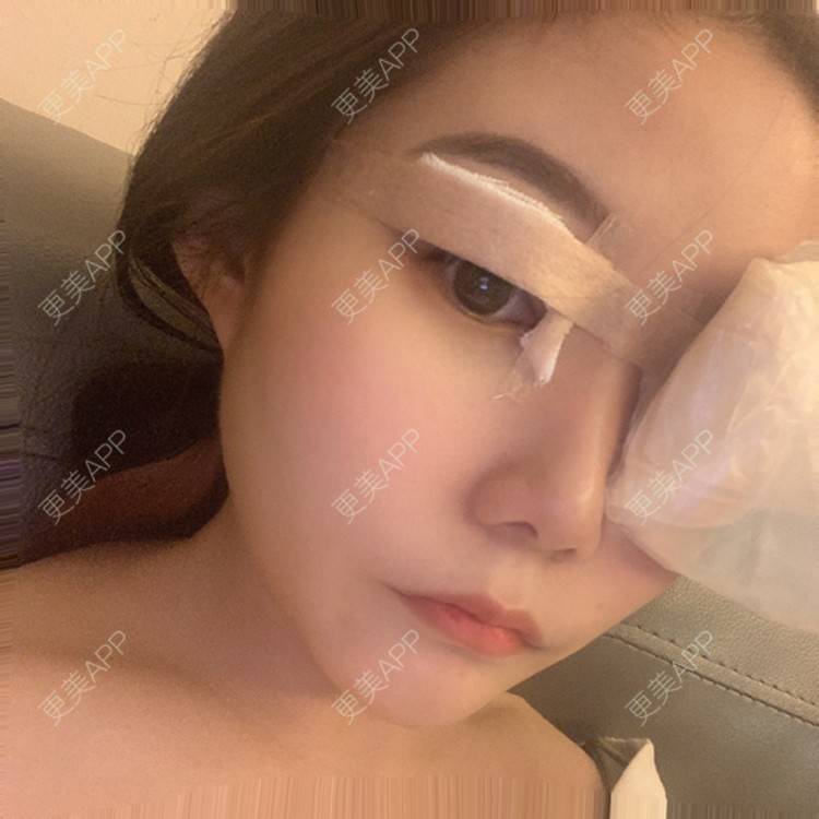 更美 - 仙人.的全切双眼皮经验 | 全切双眼皮 | 深圳
