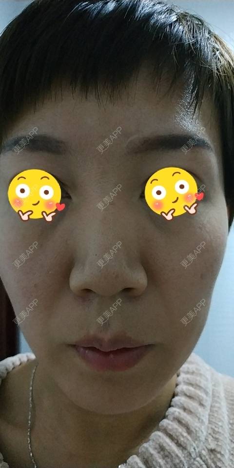 更美 - 更美用户WFzD4DOKgO的自体脂肪填充泪沟经验 | 自体脂肪丰额头 | 自体脂肪填充泪沟 | 自体脂肪丰苹果肌 | 自体脂肪隆鼻 | 自体脂肪垫下巴 | 自体脂肪丰太阳穴 | 吸脂 | 成都