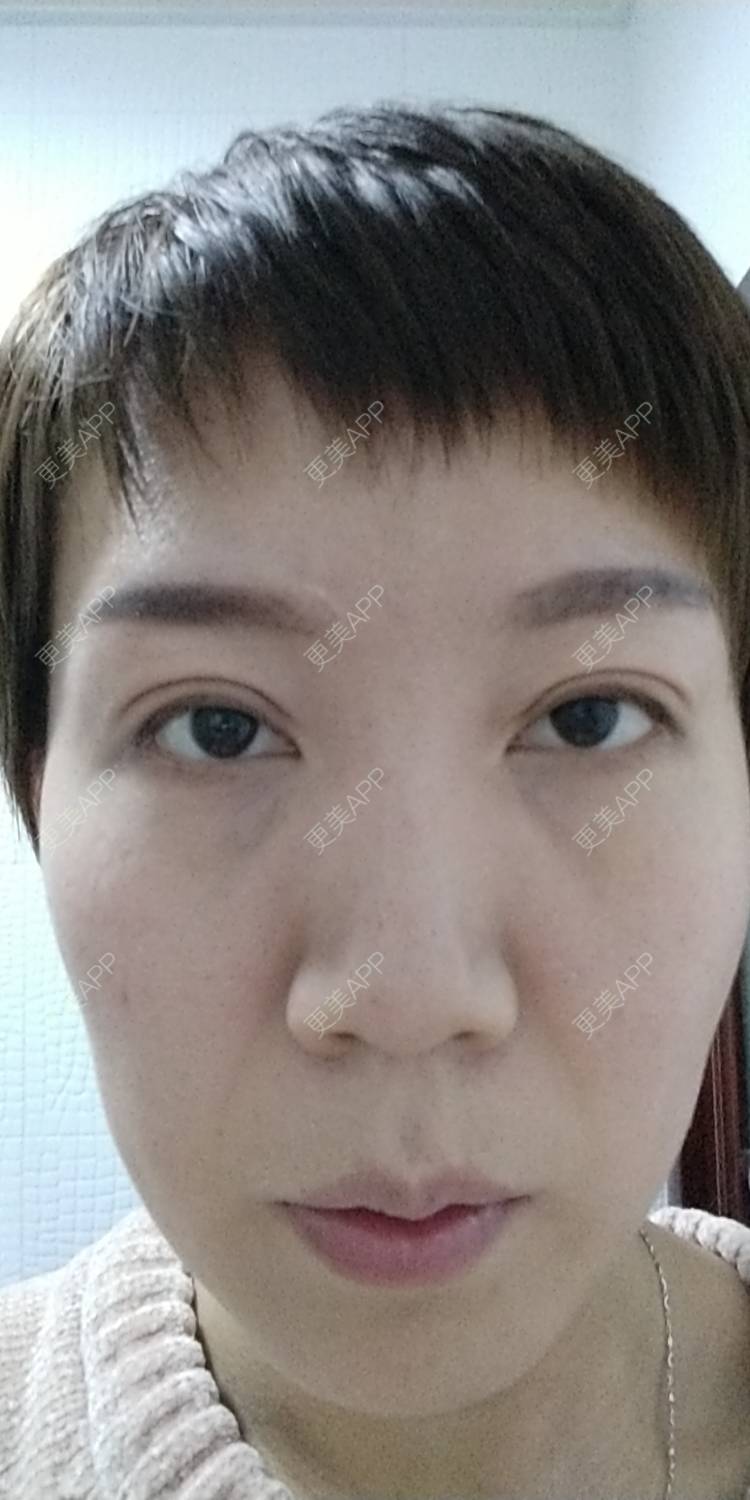 更美 - 更美用户WFzD4DOKgO的自体脂肪填充泪沟经验 | 自体脂肪填充泪沟 | 自体脂肪隆鼻 | 自体脂肪丰苹果肌 | 自体脂肪垫下巴 | 自体脂肪丰太阳穴 | 自体脂肪丰额头 | 吸脂 | 成都