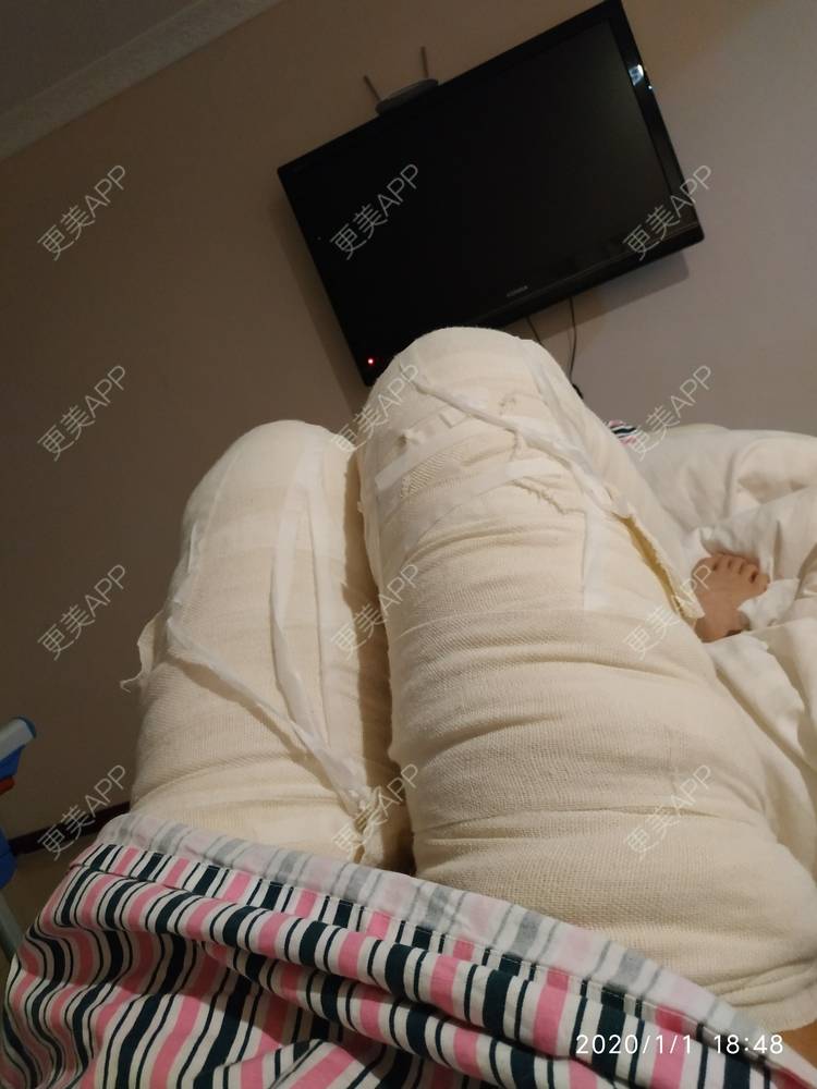 更美 - 更美用户WFzD4DOKgO的自体脂肪填充泪沟经验 | 自体脂肪填充泪沟 | 自体脂肪隆鼻 | 自体脂肪丰苹果肌 | 自体脂肪垫下巴 | 自体脂肪丰太阳穴 | 自体脂肪丰额头 | 吸脂 | 成都