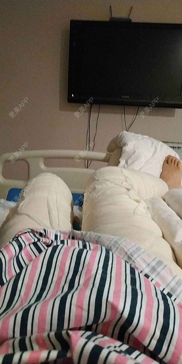 更美 - 更美用户WFzD4DOKgO的自体脂肪填充泪沟经验 | 自体脂肪填充泪沟 | 自体脂肪隆鼻 | 自体脂肪丰苹果肌 | 自体脂肪垫下巴 | 自体脂肪丰太阳穴 | 自体脂肪丰额头 | 吸脂 | 成都