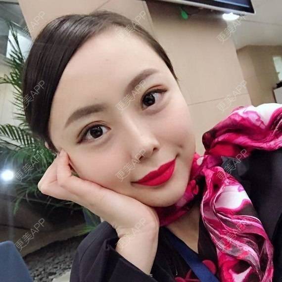 更美 - 透明女孩的玻尿酸经验 | 胶原蛋白改善法令纹 | 注射美肤 | 玻尿酸