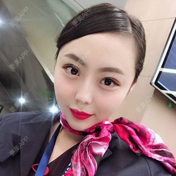 更美 - 透明女孩的玻尿酸经验 | 胶原蛋白改善法令纹 | 注射美肤 | 玻尿酸