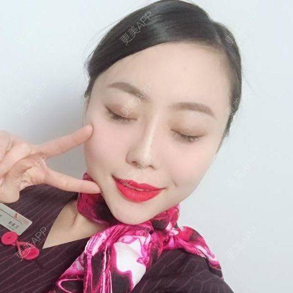 更美 - 透明女孩的玻尿酸经验 | 胶原蛋白改善法令纹 | 注射美肤 | 玻尿酸