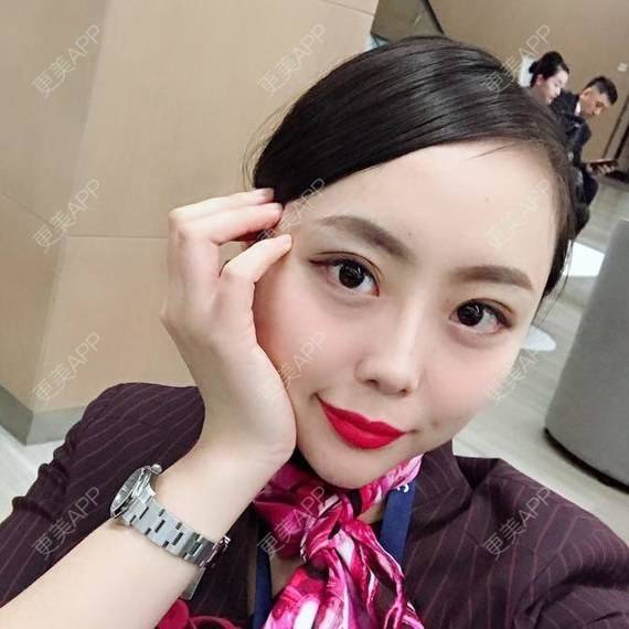 更美 - 透明女孩的玻尿酸经验 | 胶原蛋白改善法令纹 | 注射美肤 | 玻尿酸
