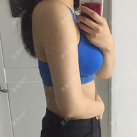 更美 - 更美用户jdZVLCsnlC的吸脂去副乳经验 | 吸脂去副乳 | 广州
