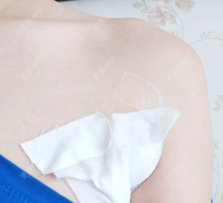 更美 - 花街、卖笑的的吸脂去副乳经验 | 吸脂去副乳