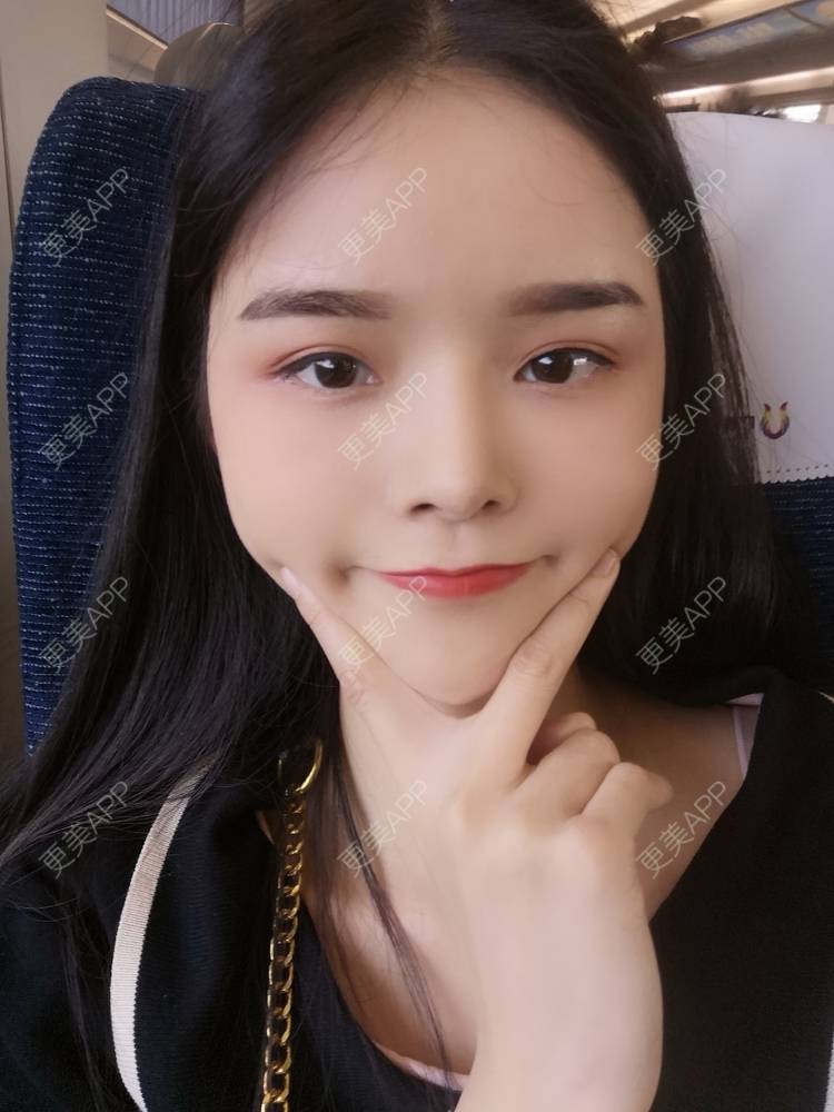 更美 - 莫宁🌸的自体脂肪填充泪沟经验 | 自体脂肪丰额头 | 自体脂肪填充泪沟 | 自体脂肪丰苹果肌 | 自体脂肪丰太阳穴 | 自体脂肪丰面颊 | 自体脂肪垫下巴 | 广州 | 视频日记