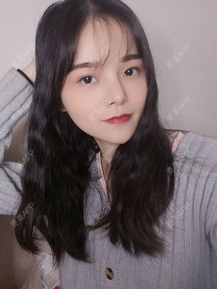 更美 - 莫宁🌸的自体脂肪填充泪沟经验 | 自体脂肪丰额头 | 自体脂肪填充泪沟 | 自体脂肪丰苹果肌 | 自体脂肪丰太阳穴 | 自体脂肪丰面颊 | 自体脂肪垫下巴 | 广州 | 视频日记