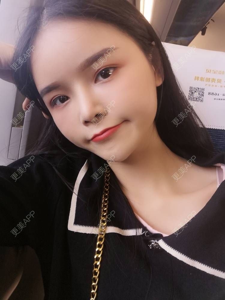 更美 - 莫宁🌸的自体脂肪填充泪沟经验 | 自体脂肪丰额头 | 自体脂肪填充泪沟 | 自体脂肪丰苹果肌 | 自体脂肪丰太阳穴 | 自体脂肪丰面颊 | 自体脂肪垫下巴 | 广州 | 视频日记