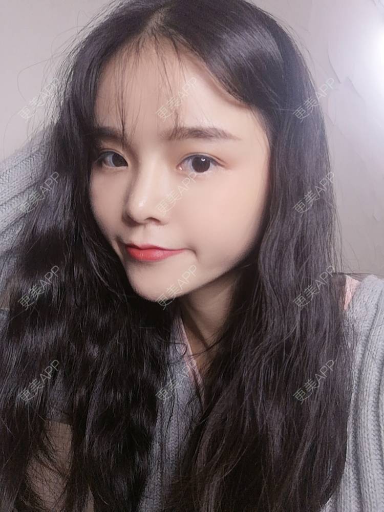 更美 - 莫宁🌸的自体脂肪填充泪沟经验 | 自体脂肪丰额头 | 自体脂肪填充泪沟 | 自体脂肪丰苹果肌 | 自体脂肪丰太阳穴 | 自体脂肪丰面颊 | 自体脂肪垫下巴 | 广州 | 视频日记