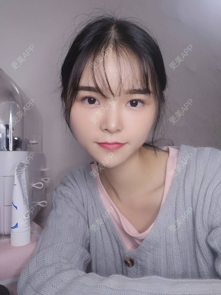 更美 - 莫宁🌸的自体脂肪填充泪沟经验 | 自体脂肪丰额头 | 自体脂肪填充泪沟 | 自体脂肪丰苹果肌 | 自体脂肪丰太阳穴 | 自体脂肪丰面颊 | 自体脂肪垫下巴 | 广州 | 视频日记