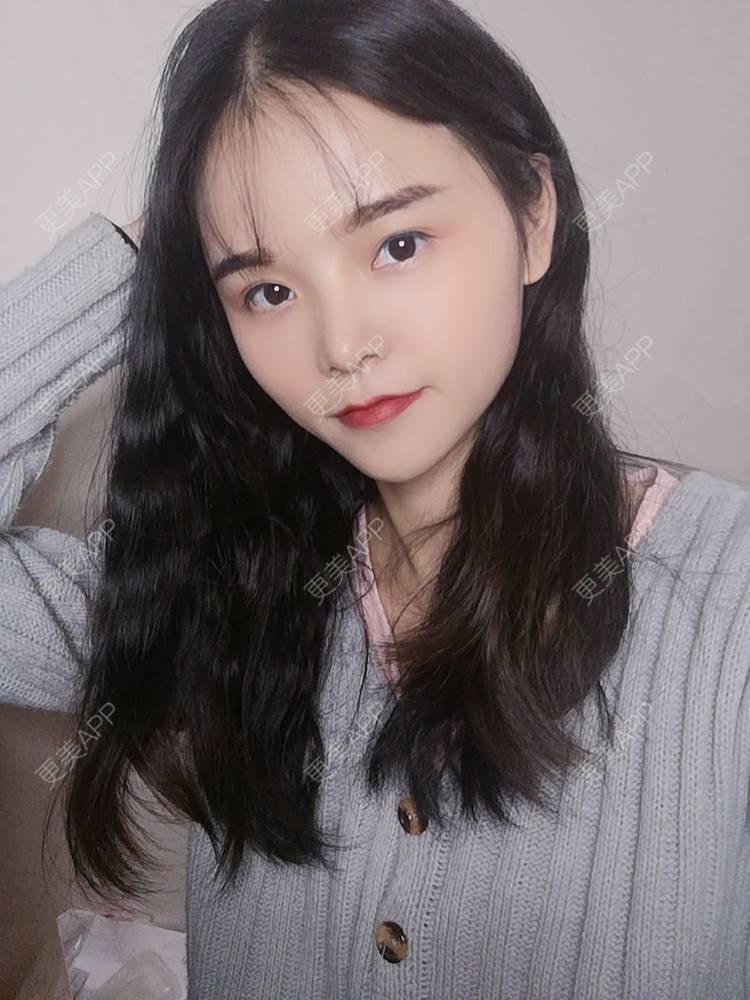 更美 - 莫宁🌸的自体脂肪填充泪沟经验 | 自体脂肪丰额头 | 自体脂肪填充泪沟 | 自体脂肪丰苹果肌 | 自体脂肪丰太阳穴 | 自体脂肪丰面颊 | 自体脂肪垫下巴 | 广州 | 视频日记