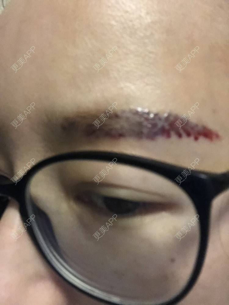 更美用户wrk8qcl0zq的激光洗眉日记