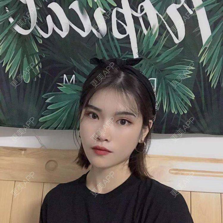 更美 - 更美用户jSOVPCJfqQ的玻尿酸太阳穴经验 | 玻尿酸太阳穴 | 玻尿酸唇部 | 玻尿酸面部细纹
