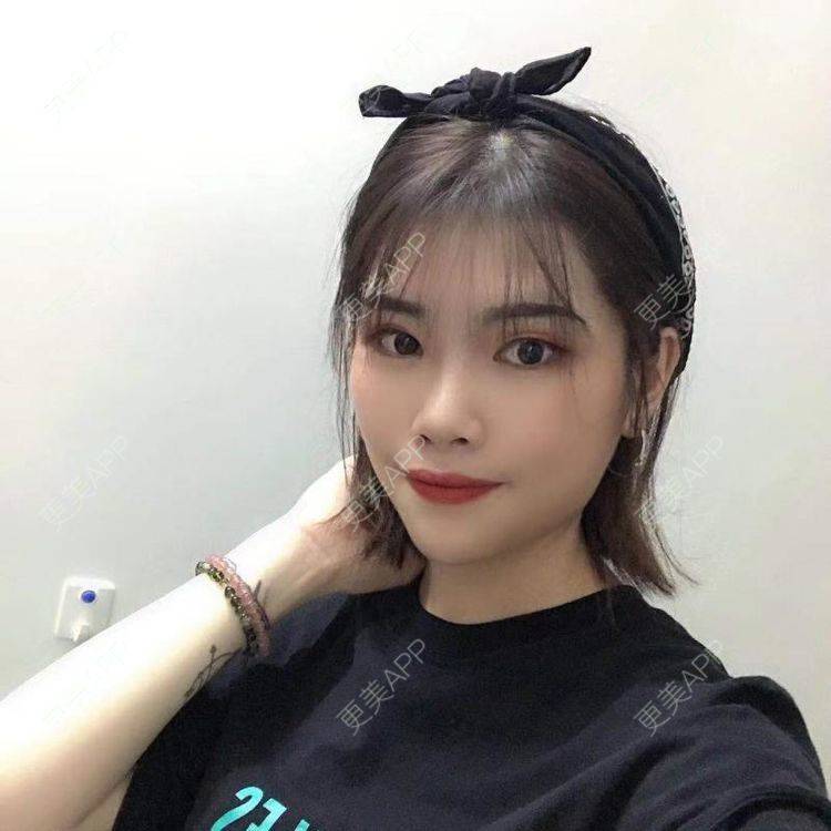 更美 - 更美用户jSOVPCJfqQ的玻尿酸太阳穴经验 | 玻尿酸太阳穴 | 玻尿酸唇部 | 玻尿酸面部细纹