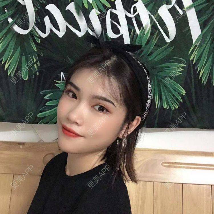 更美 - 更美用户jSOVPCJfqQ的玻尿酸太阳穴经验 | 玻尿酸太阳穴 | 玻尿酸唇部 | 玻尿酸面部细纹