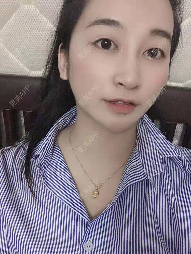 更美 - 更美用户129LF9Yh6a的玻尿酸下巴经验 | 视频日记 | 玻尿酸下巴 | 广州