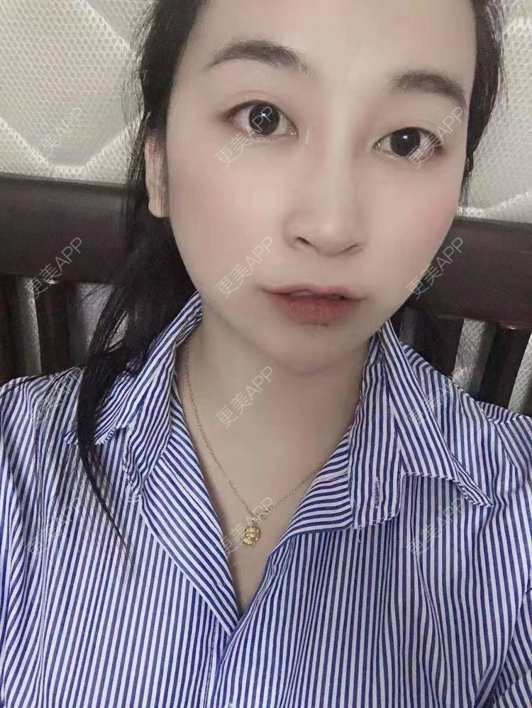 更美 - 更美用户129LF9Yh6a的玻尿酸下巴经验 | 视频日记 | 玻尿酸下巴 | 广州