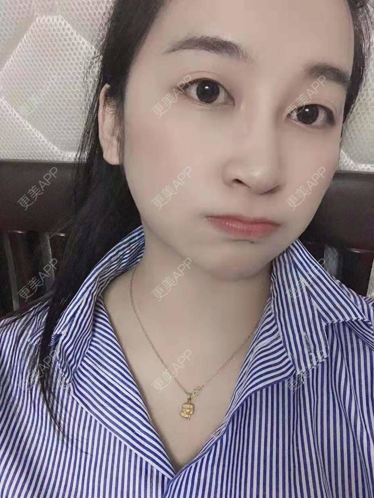 更美 - 更美用户129LF9Yh6a的玻尿酸下巴经验 | 视频日记 | 玻尿酸下巴 | 广州