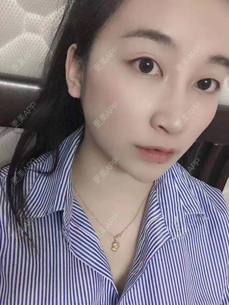 更美 - 更美用户129LF9Yh6a的玻尿酸下巴经验 | 视频日记 | 玻尿酸下巴 | 广州