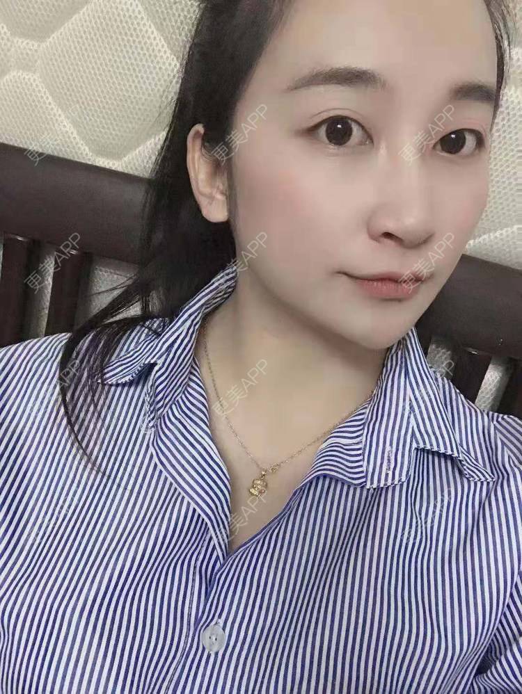 更美 - 更美用户129LF9Yh6a的玻尿酸下巴经验 | 视频日记 | 玻尿酸下巴 | 广州