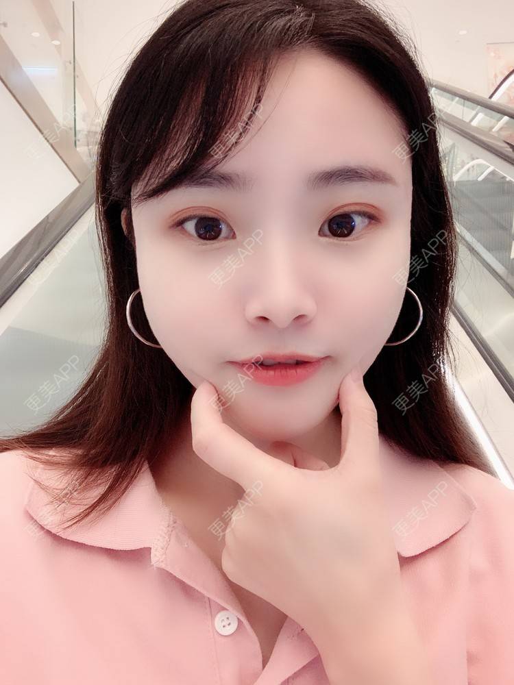 更美 - 大美人图的自体脂肪丰额头经验 | 更美研究所 | 杭州 | 自体脂肪丰额头