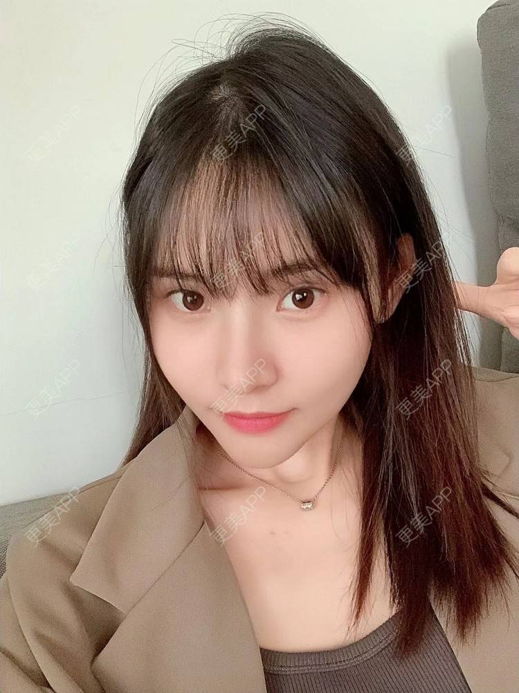 更美 - 大美人图的自体脂肪丰额头经验 | 更美研究所 | 杭州 | 自体脂肪丰额头