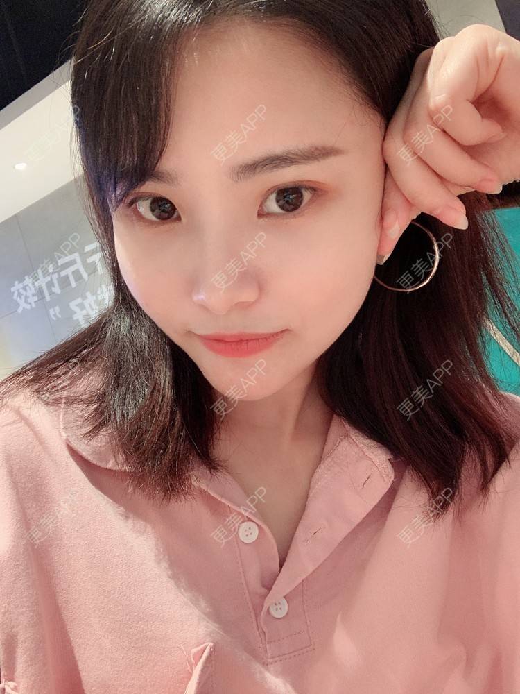 更美 - 大美人图的自体脂肪丰额头经验 | 更美研究所 | 杭州 | 自体脂肪丰额头