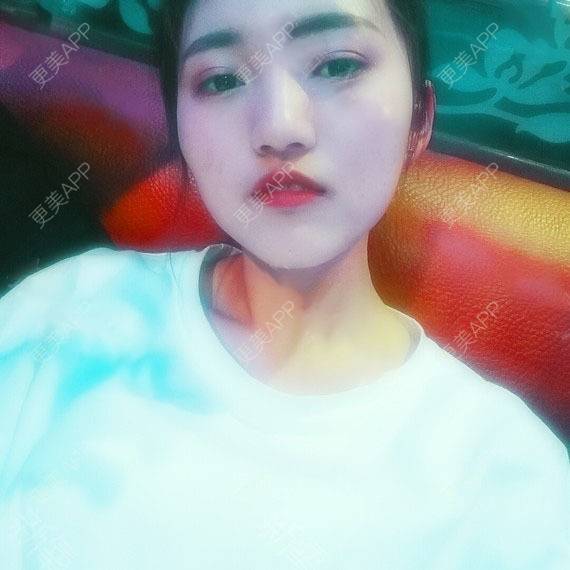 更美 - 天涯甜甜的果酸焕肤经验 | 果酸焕肤 | 六盘水