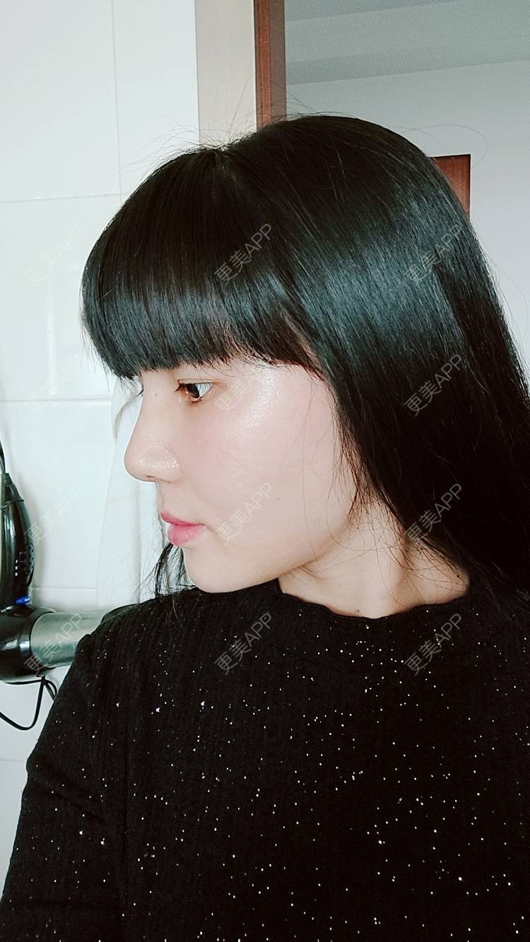 更美 - 欣欣的植发际线经验 | 植发际线 | 东莞