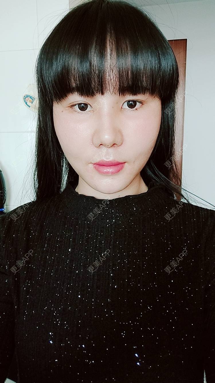 更美 - 欣欣的植发际线经验 | 植发际线 | 东莞
