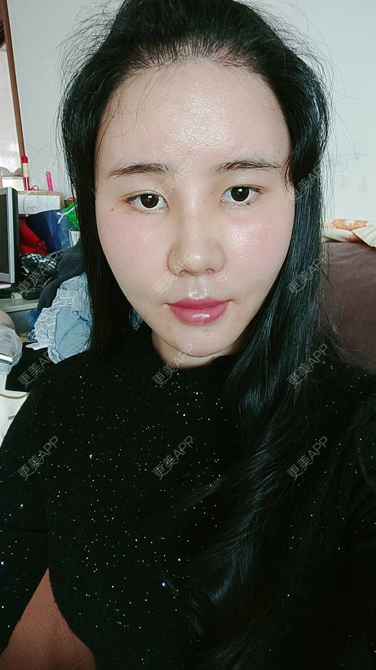 更美 - 欣欣的植发际线经验 | 植发际线 | 东莞