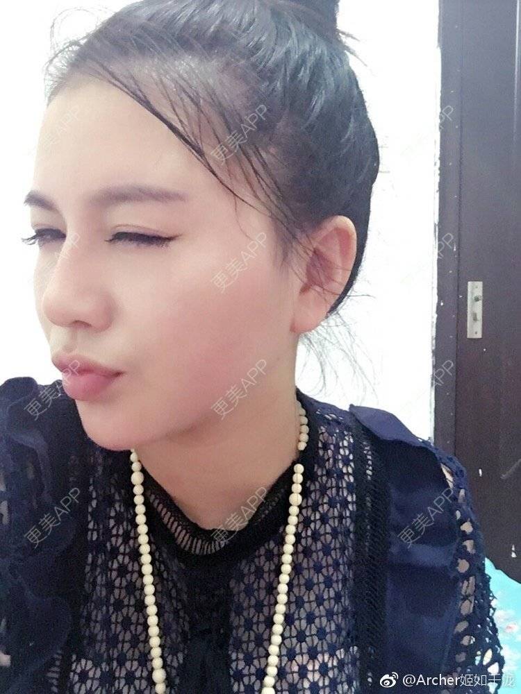 更美 - Aryan Gabbar的驼峰鼻矫正经验 | 驼峰鼻矫正 | 鹰钩鼻矫正 | 西安 | 鼻小柱延长