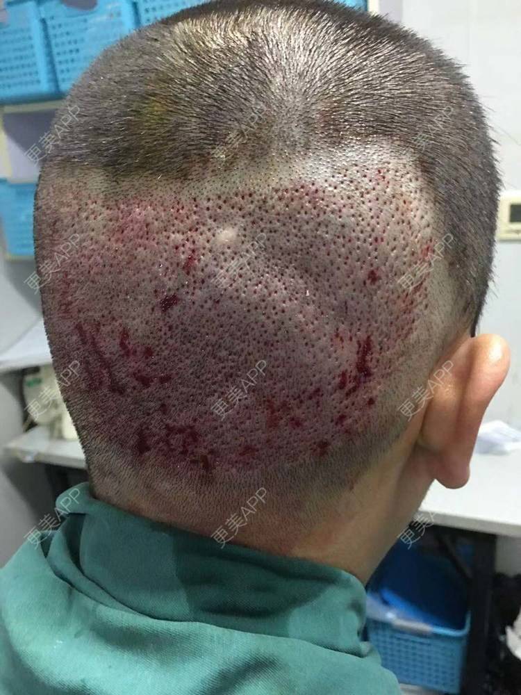 更美用户tsosmpmkgj的植发际线日记